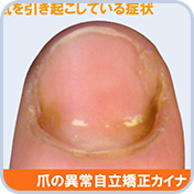 爪の病気、爪の異常